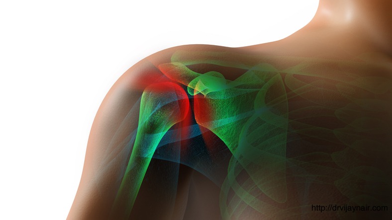 Calcific Shoulder Tendonitis