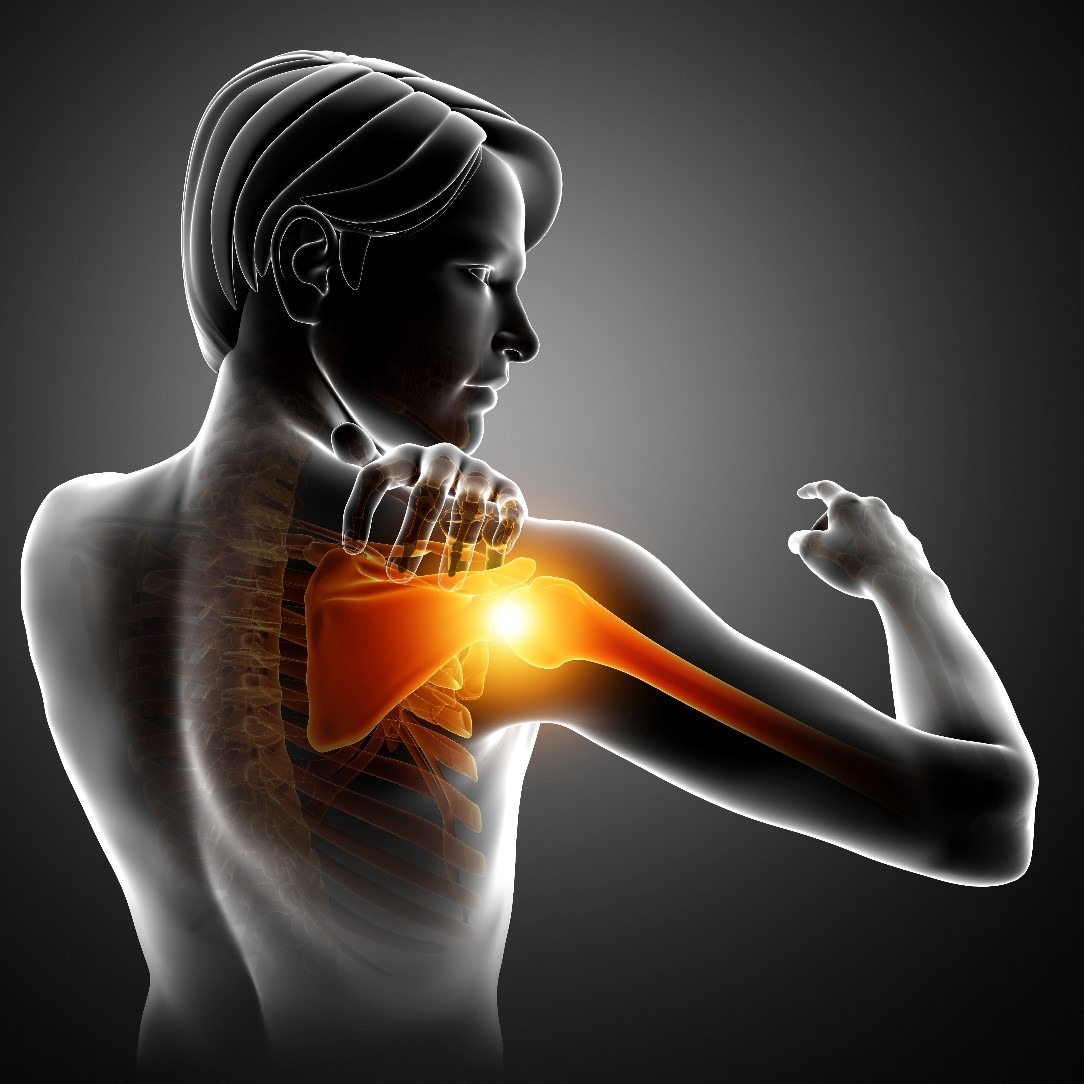 Acromioclavicular (AC) Joint Separation