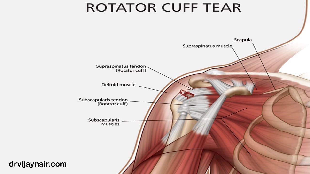 Rotator Cuff Tear