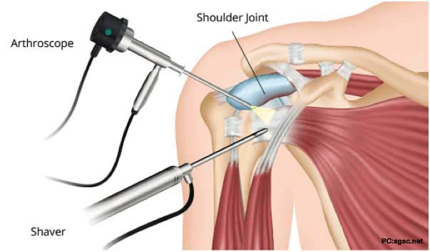 Shoulder_Arthroscopy