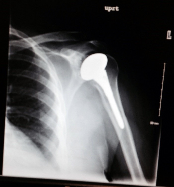 Shoulder Replacement