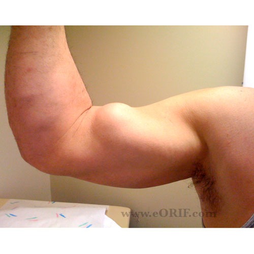 Biceps Injury Case Study