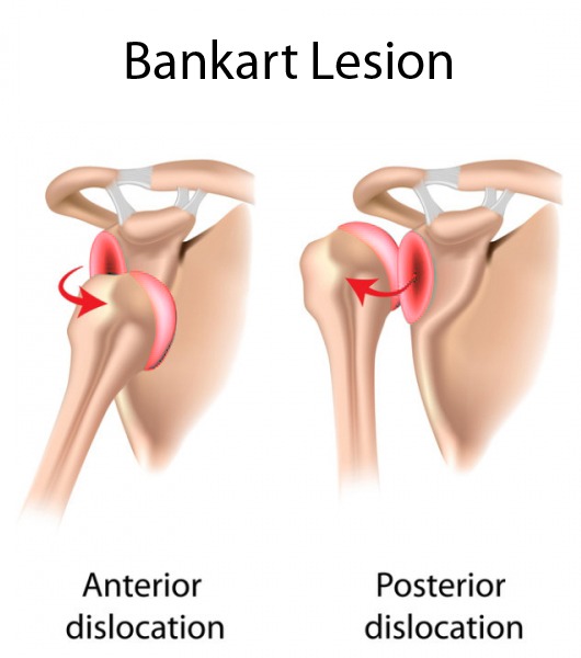 bankart lesion