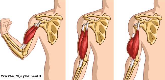 Biceps Tendon Rupture
