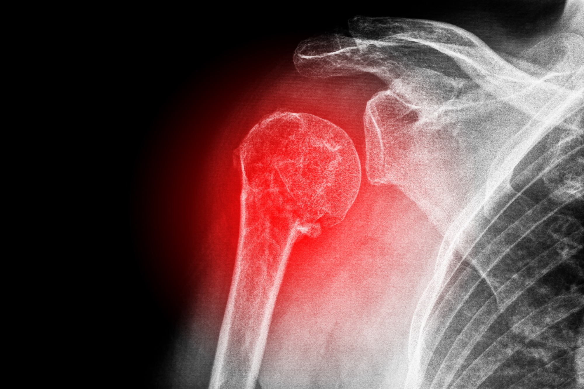 SUBCORACOID IMPINGEMENT