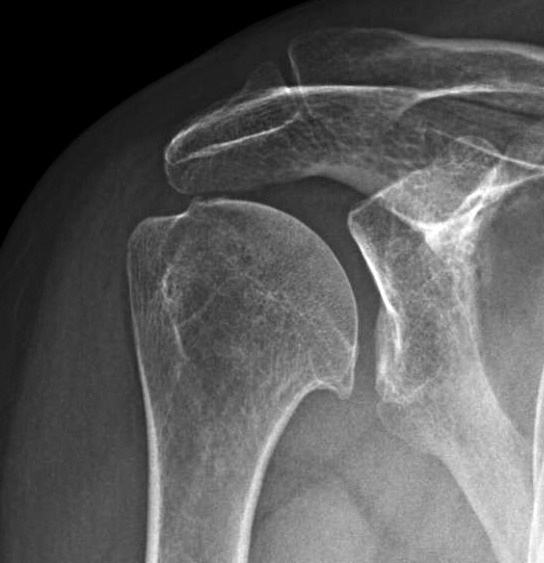 Glenohumeral Arthritis