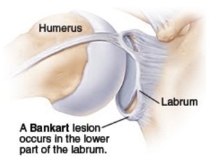 bankart lesion