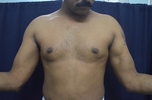 Ruptured biceps