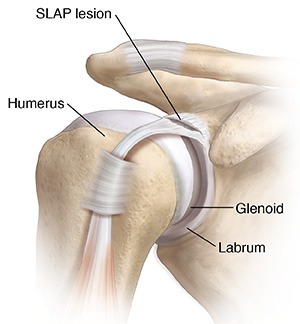 Front view of shoulder joint showing SLAP lesion