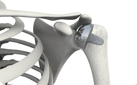 Shoulder Resurfacing