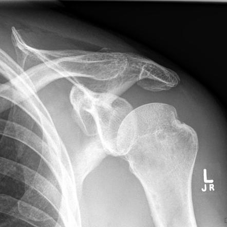 Hill Sachs Lesion
