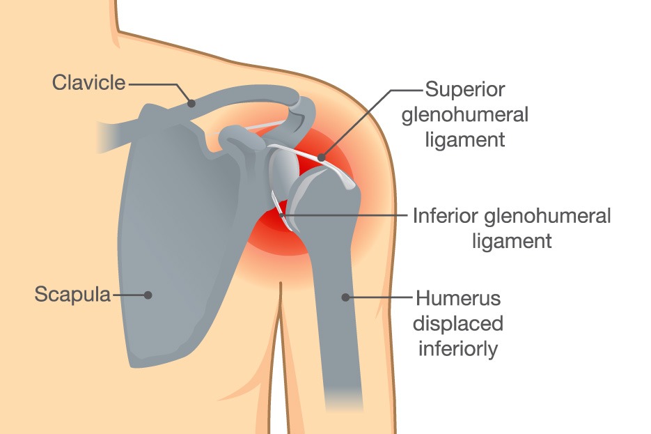 ShoulderDislocation_Ilustration.