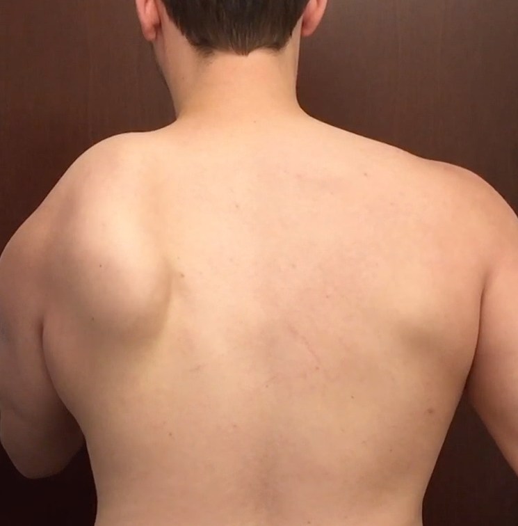 Scapular_Injury