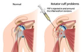 Rotator_Cuff_Tear