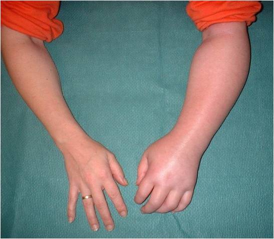 Shoulder_Hand_Syndrome