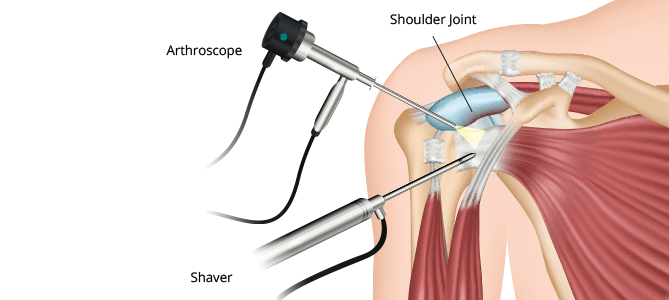 Shoulder-Arthroscopy