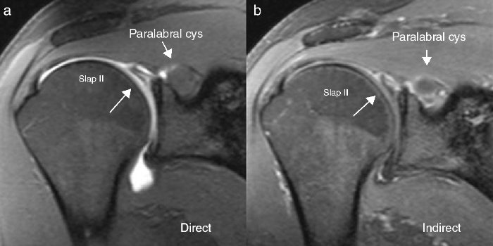 Paralabral_Cyst_In_The_Shoulder