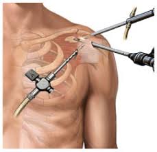 Types_Of_Shoulder_Surgery