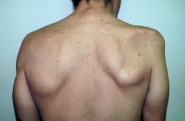 Parsonage_Turner_Syndrome