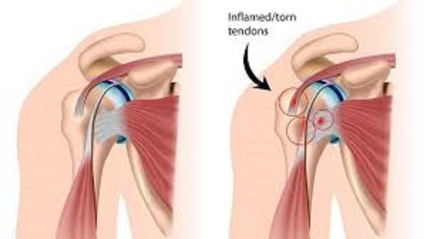 Shoulder Tendinopathy