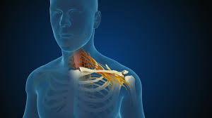 Cervical_Radiculopathy