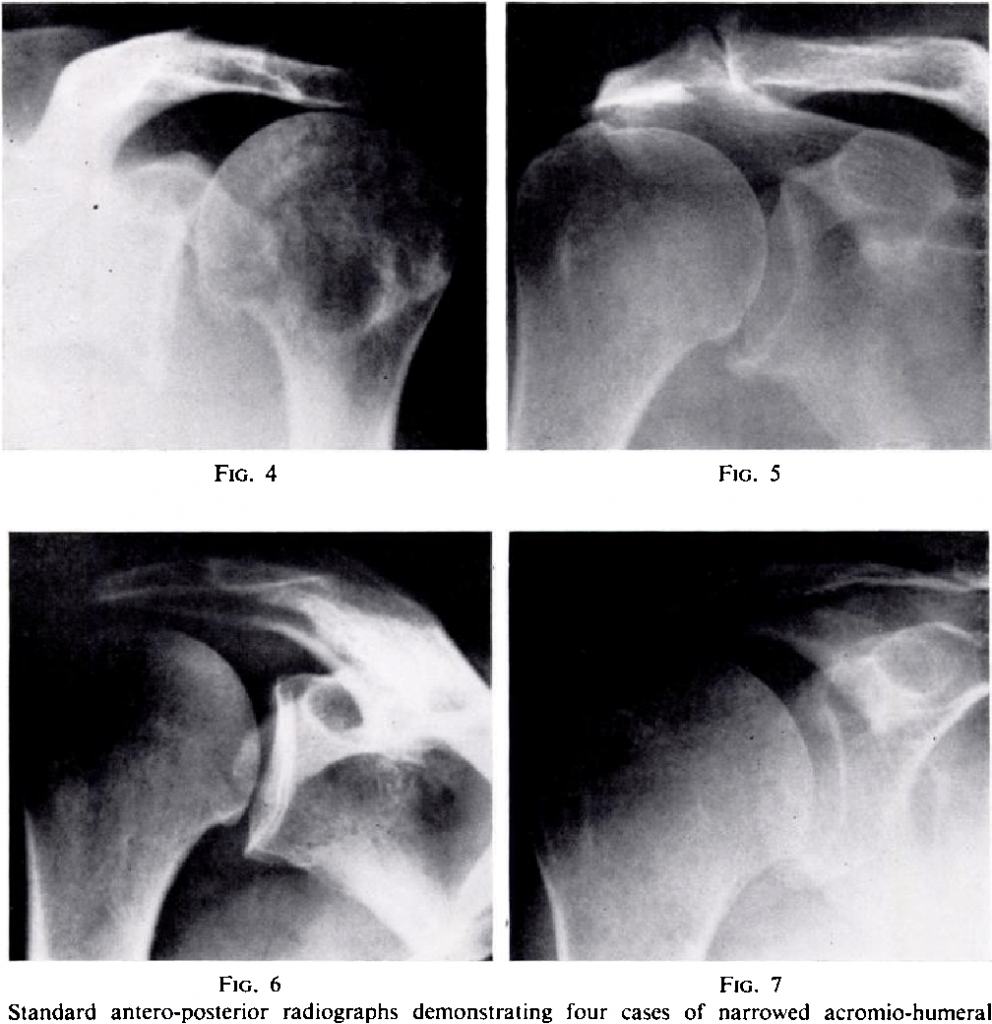 Superior and Anterior-Superior Migration of the Shoulder