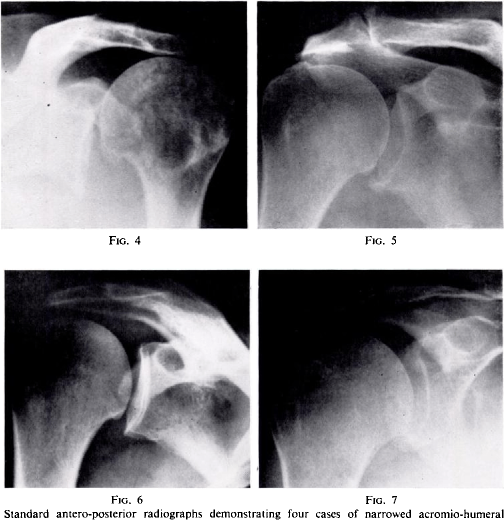 Superior and Anterior-Superior Migration of the Shoulder