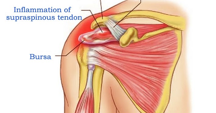 Supraspinatus-Tendinosis