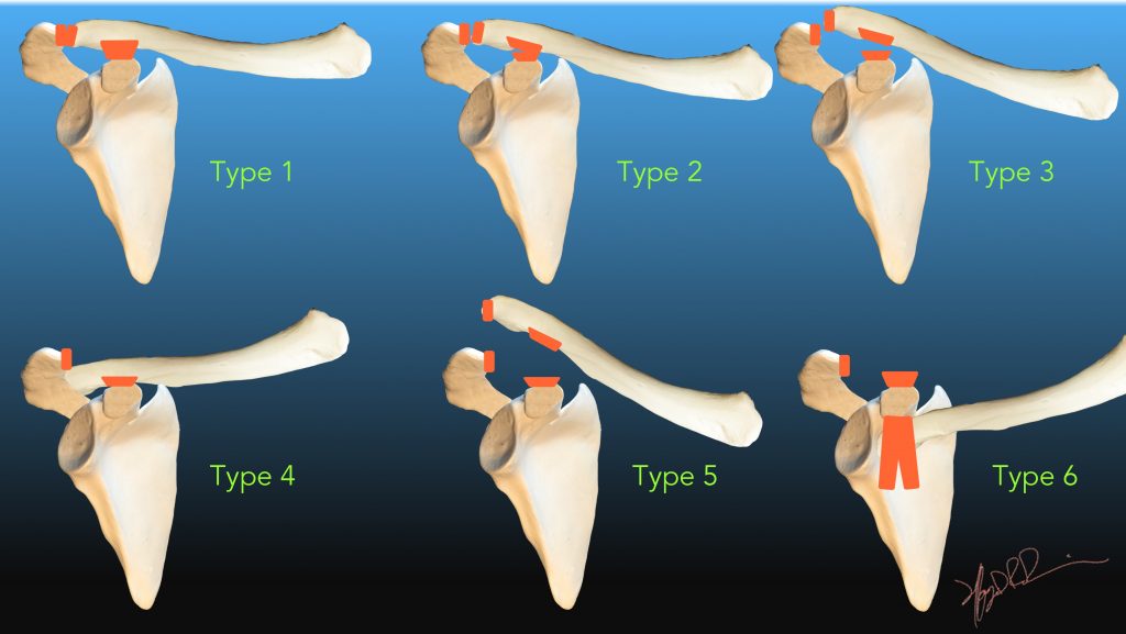 AC-Joint-Separation