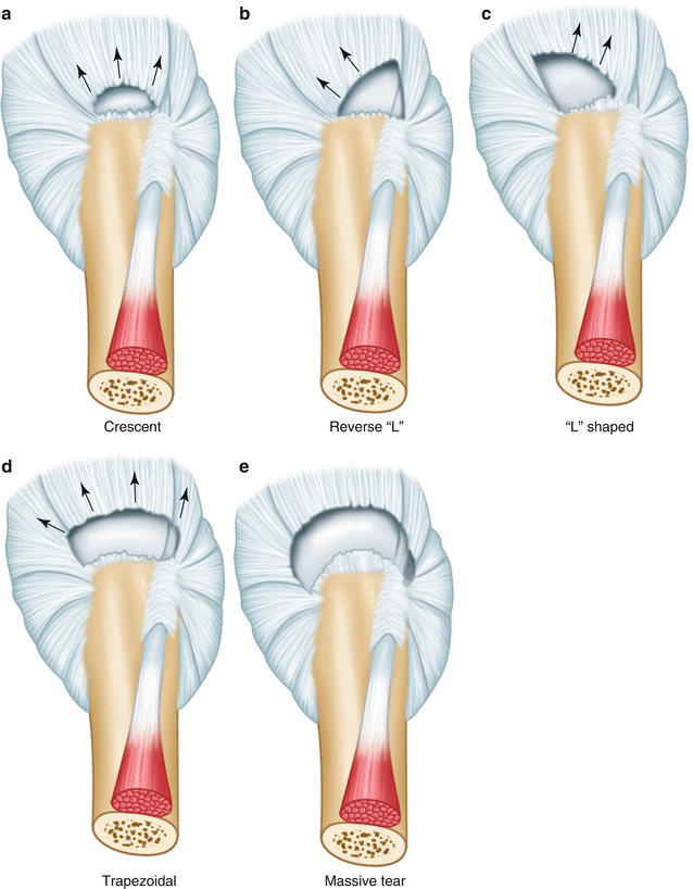 Types_Of_Rotator_Cuff_Tears