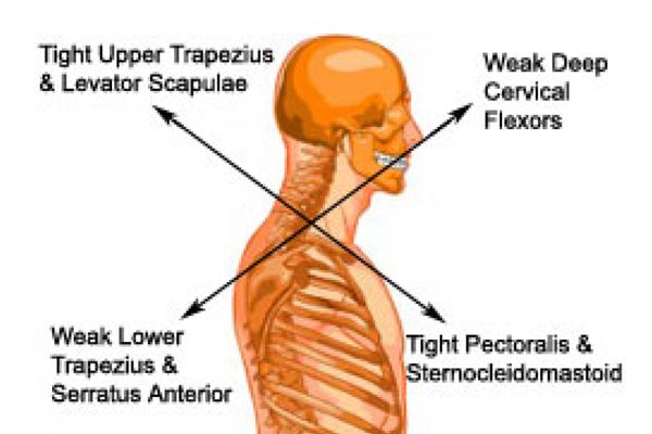 UPPER-CROSSED-SYNDROME