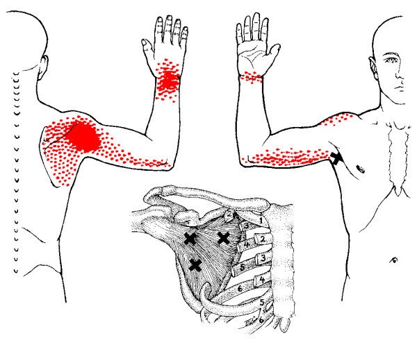 Referred_Shoulder_Pain