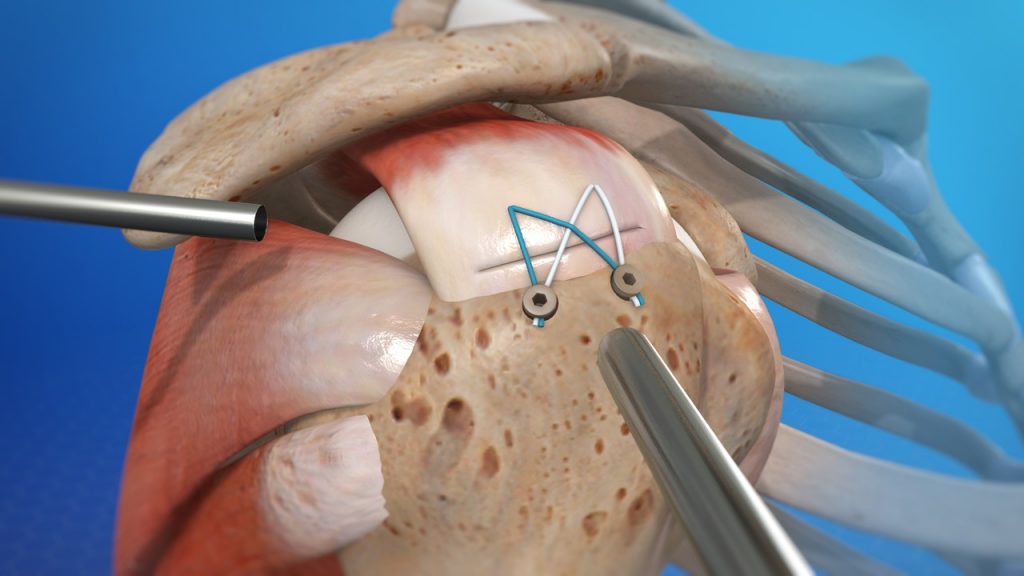 Shoulder_Arthroscopy_For_Rotator_Cuff_Repair