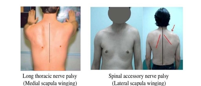 Nreve Palsy