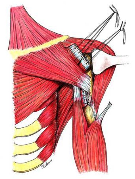 Muscle Transfer for Irreparable Tears