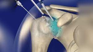Shoulder Arthritis Debridement