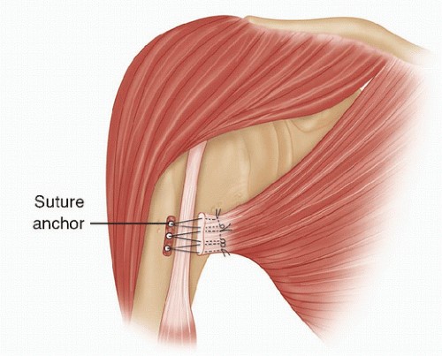 Pectoralis Major Repair