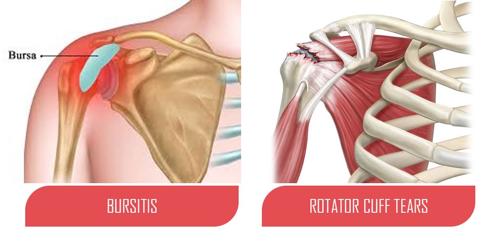 Rotator Cuff Tear Versus Bursitis