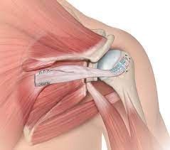 Tendon Transfer for Irreparable Rotator Cuff Tears