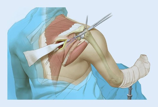 Arthroscopic Lower Trapezius Transfer