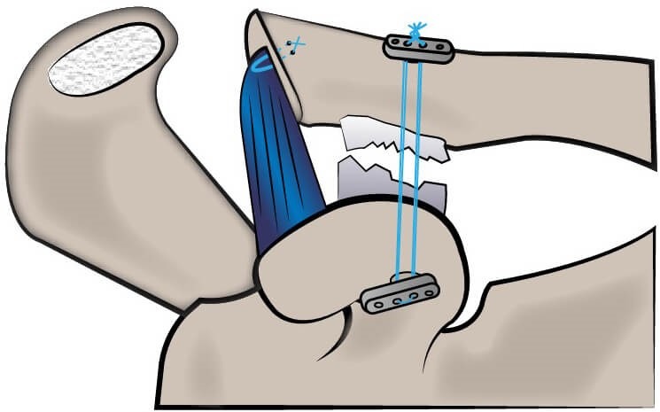 Acromioclavicular (AC) Joint Injury Repair