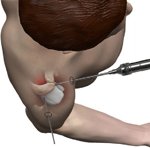 Arthroscopic posterior capsulolabral repair