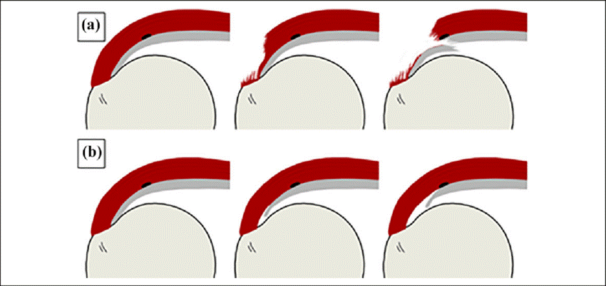 Bursal-sided rotator cuff tears