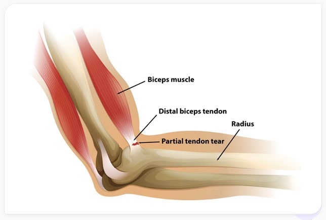 Distal biceps rupture