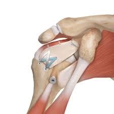 SpeedBridge Rotator Cuff Tears