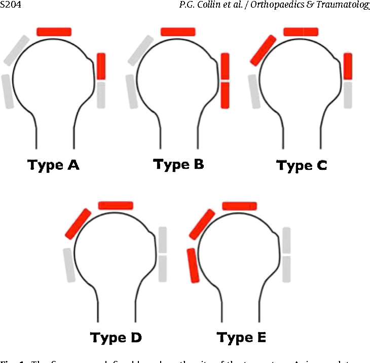Types of Rotator cuff injuries