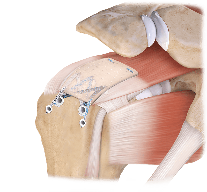 SpeedBridge rotator cuff repair