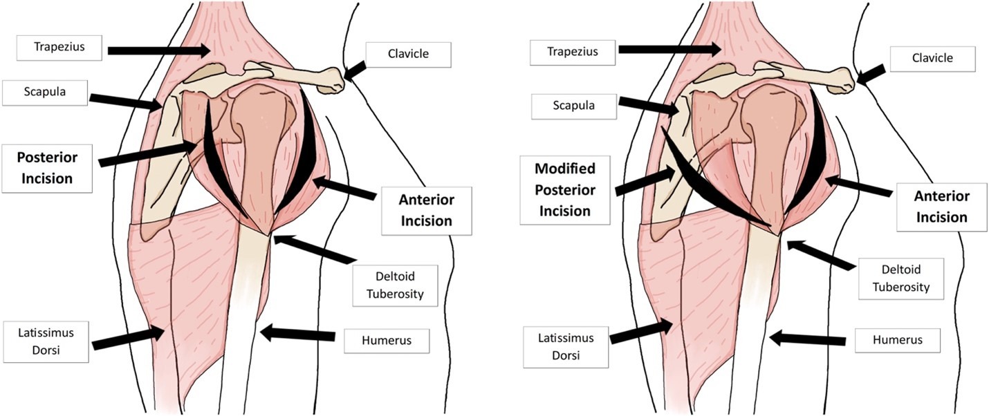 Deltoid Compartment Syndrome