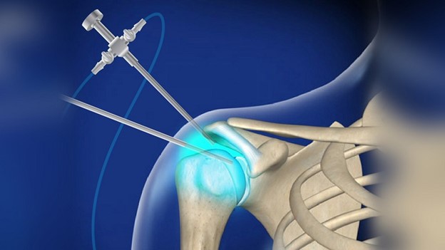 Shoulder Arthritis Debridement