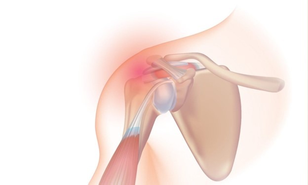 Multidirectional Shoulder Instability